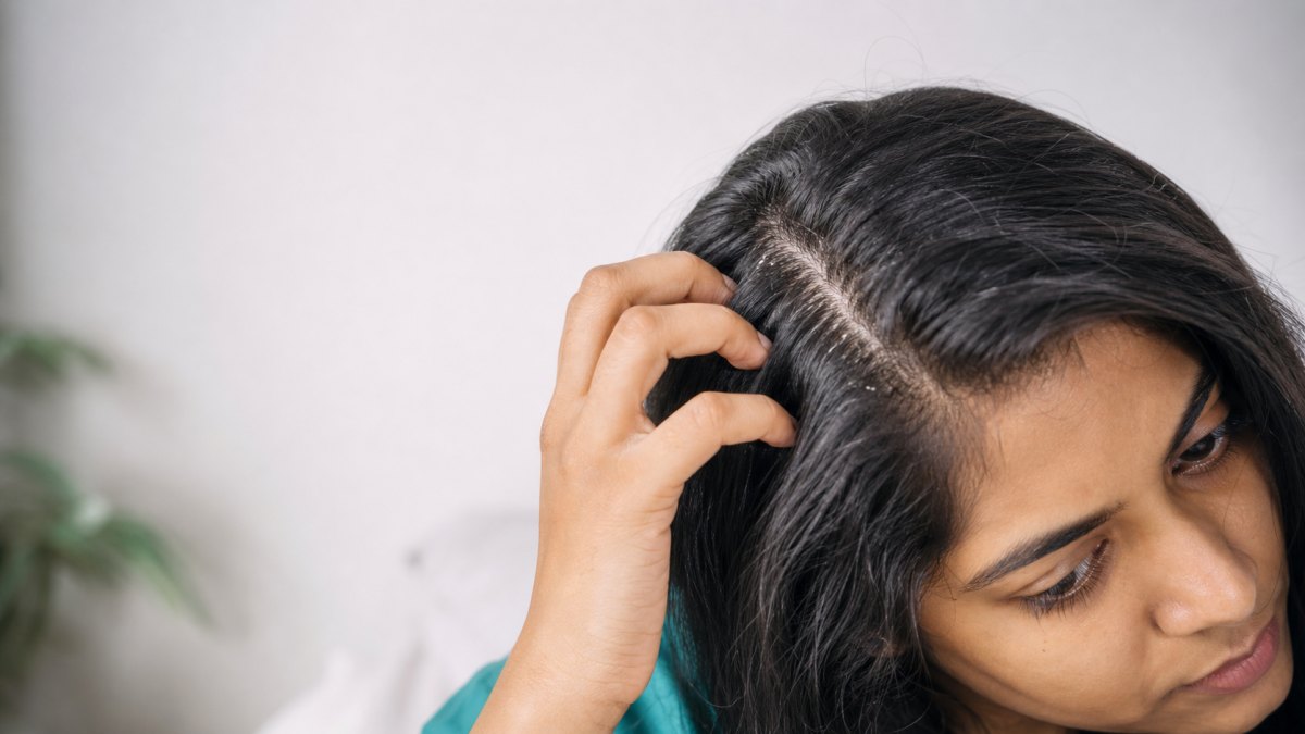 Indian woman examining visible dandruff flakes and an itchy scalp