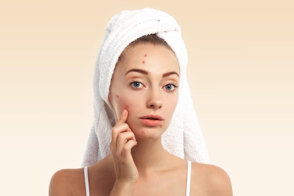 Acne Homeopathy Treatment in Pune
