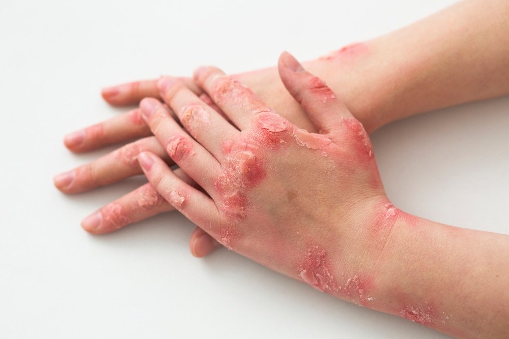 Psoriasis Homeopathy Treatment in Pune