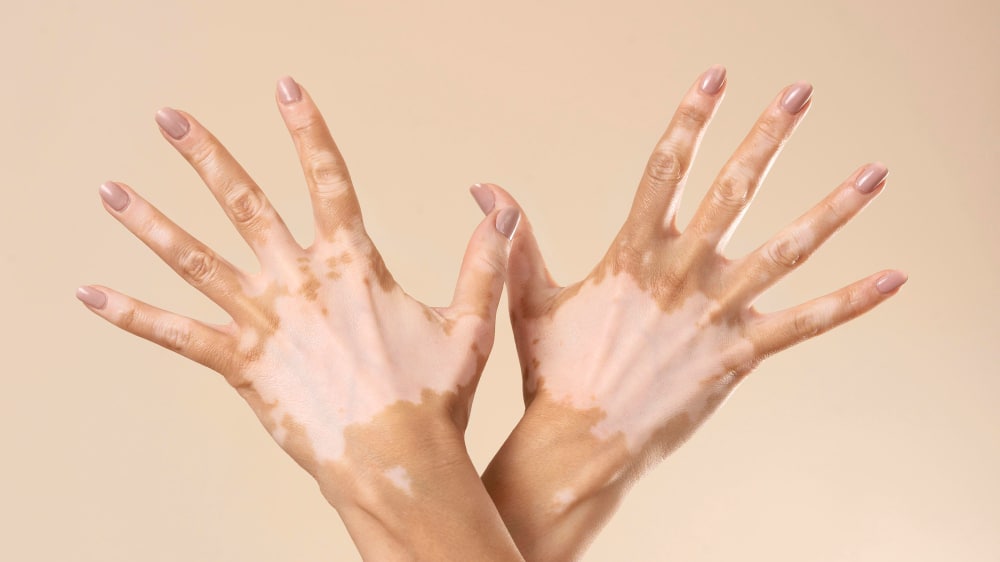 Vitiligo Homeopathy Treatment in Pune